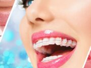 Брекеты Damon: виды, особенности, преимущества